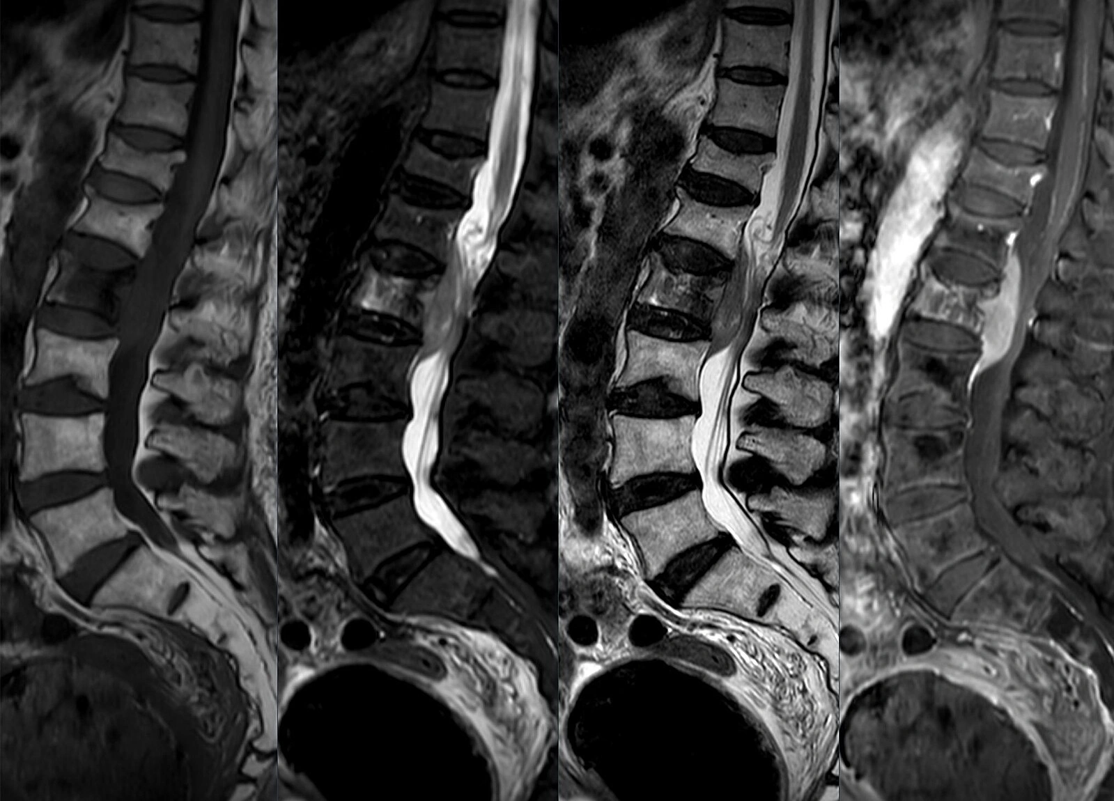 Wie sieht eine Spinalkanalstenose aus? - Röntgenbild